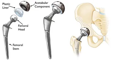 Como é a cirurgia de prótese do quadril?